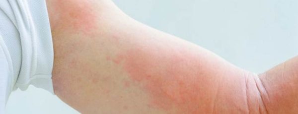  Allergia ai cavoli
